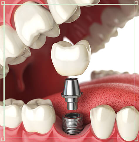 graphic of dental implant being placed in lower jaw