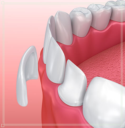 illustration of a dental veneer being placed on a tooth