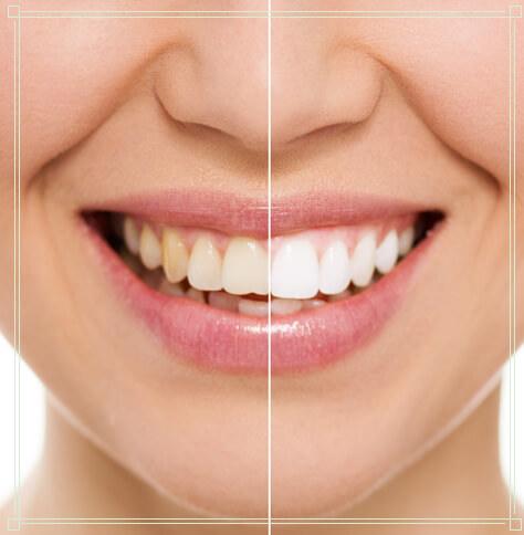 A before and after photo showing a woman's smile after professional teeth whitening.