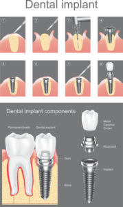Dental implant is an artificial tooth root that is placed into your jaw to hold a replacement tooth or bridge. Dental implants may be an option for people who have lost a tooth or teeth due to periodontal disease, an injury, or some other reason. Vector graphic design.