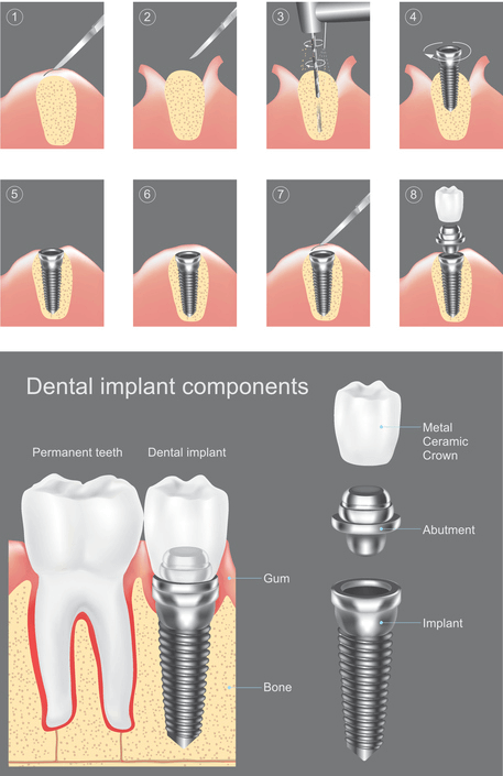 graphic of dental implant stages