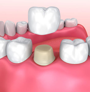 Dental crown graphic