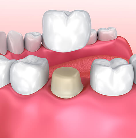 illustration of the dental crown process