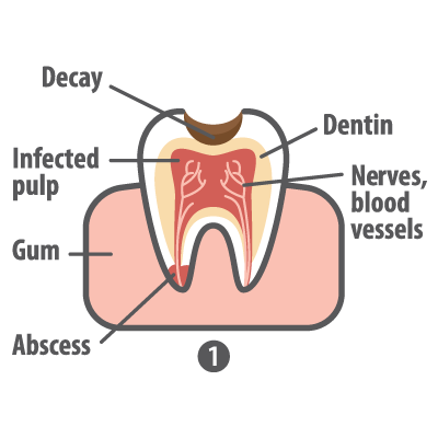 Root canal diagram