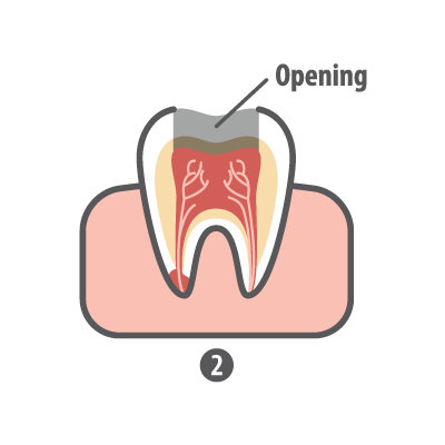 Root canal step 2 opening