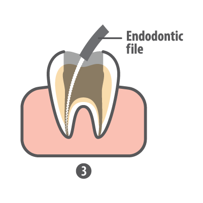 Root canal step 3 endodontic file