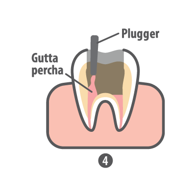 Root Canal step 4 Gutta Percha