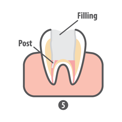 Root Canal Step 5 Filling