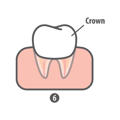 Root Canal Step 6 Crown