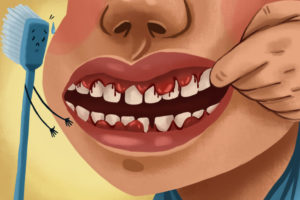 Our dentist in Jonesboro AR can explain health conditions that cause bleeding gums.