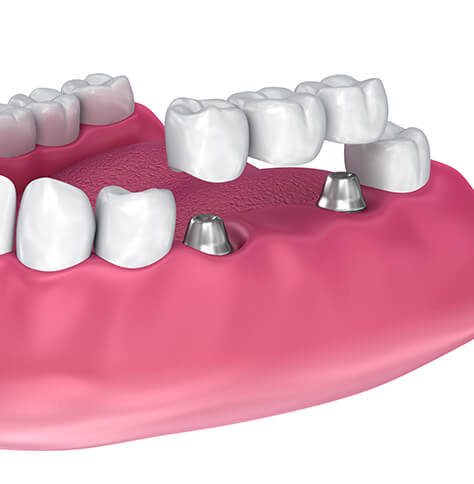 illustration of a dental bridge