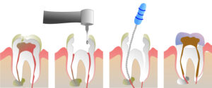 Graphic showing the root canal procedure.