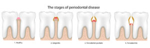 Graphic showing steps of gum disease or periodontal disease.