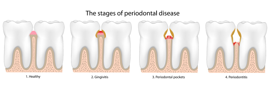 Graphic showing steps of gum disease or periodontal disease.