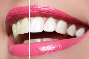 Close up of a smile before and after professional teeth whitening.