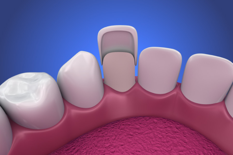 Model of a mouth showing the placement of a dental veneer on one tooth.