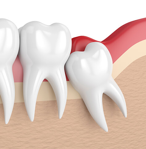 illustration of an impacted wisdom tooth