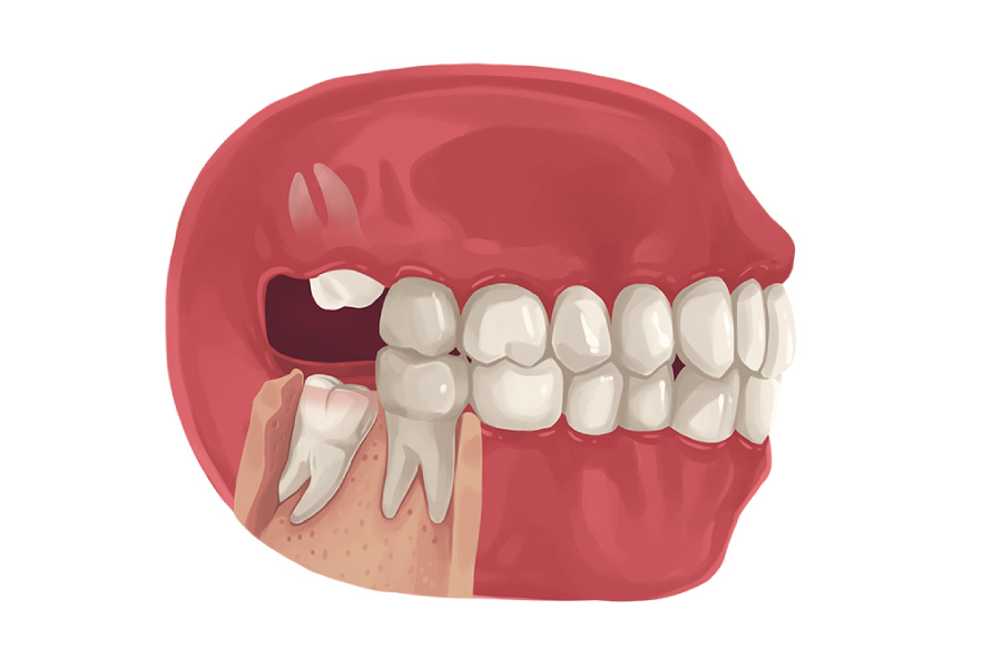 Model showing wisdom teeth growing improperly.