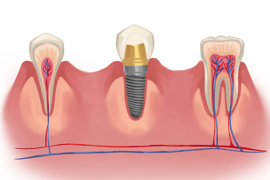 Graphic of a dental implant in between two natural teeth.